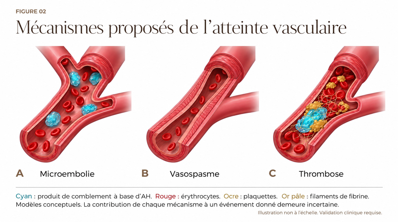 Trois coupes conceptuelles de vaisseaux montrant des microemboles intraluminaux d’AH, une lumière rétrécie par un vasospasme et une thrombose plaquettaire et fibrineuse à côté d’un produit de comblement à base d’AH.